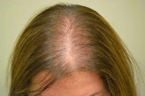 alopecia