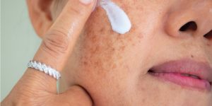 mulher com melasma passando protetor