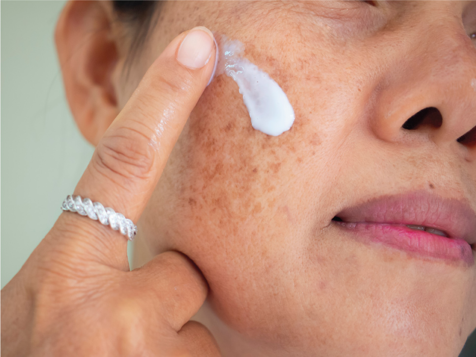 mulher com melasma passando protetor