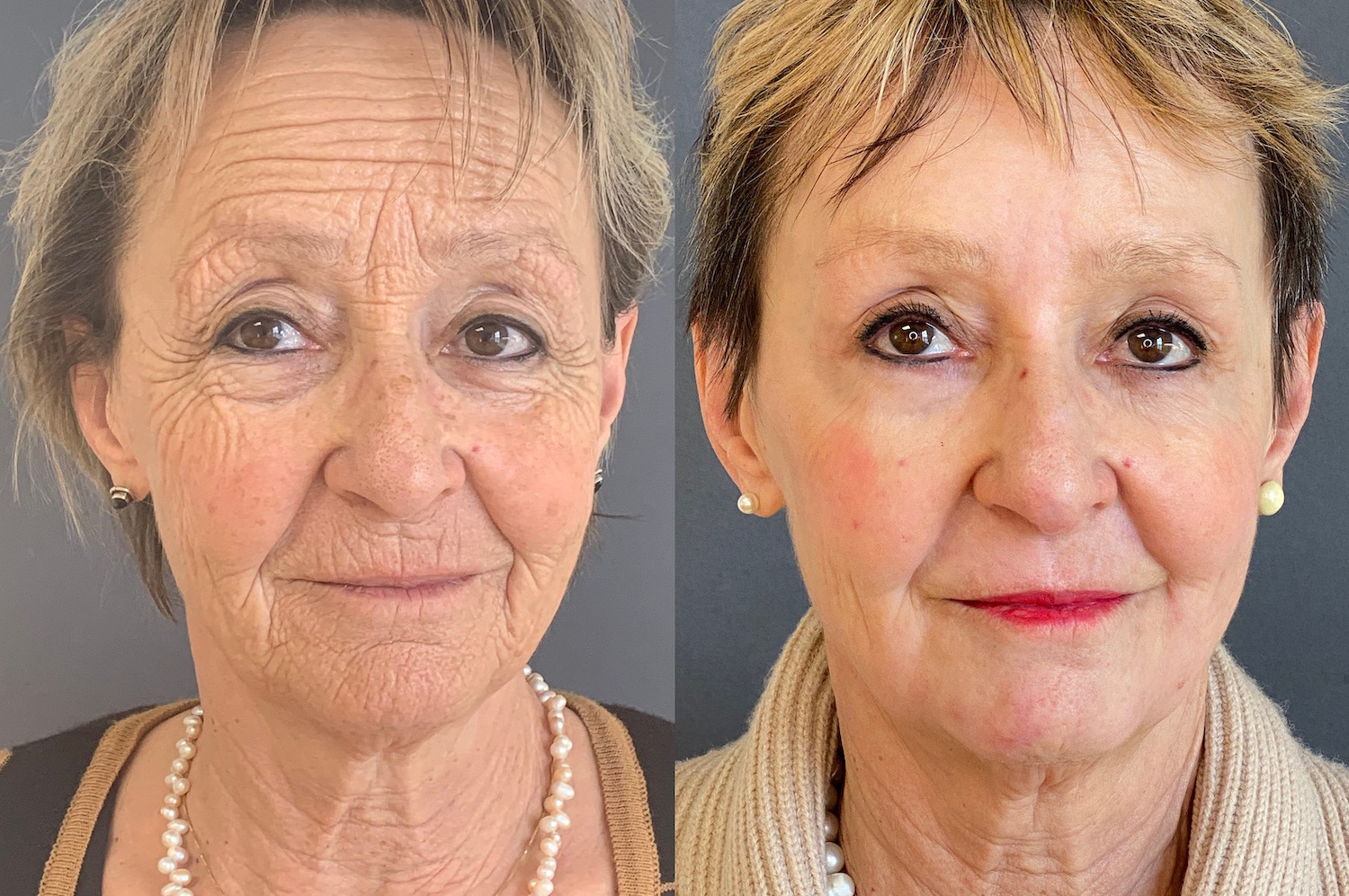 antes e depois de peeling de fenol